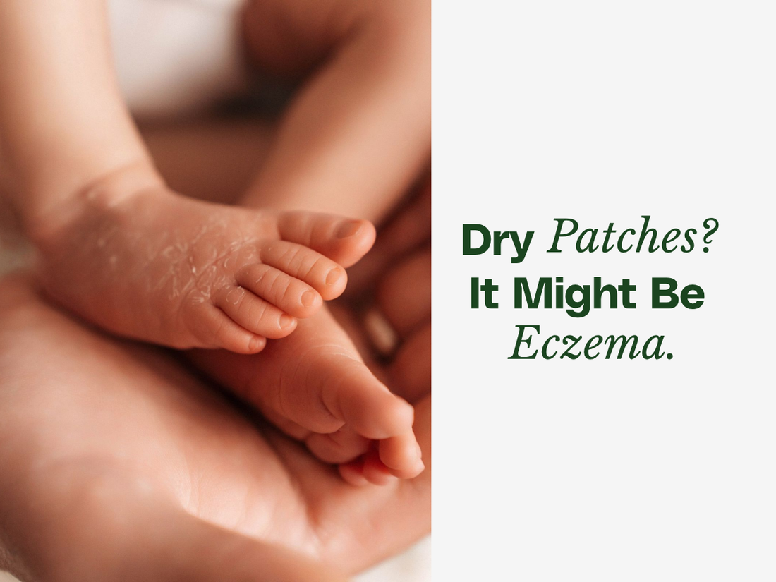 My Baby Has Dry, Itchy Patches — Could It Be Eczema?